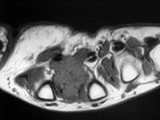 Figure 3 for case Glomus tumors